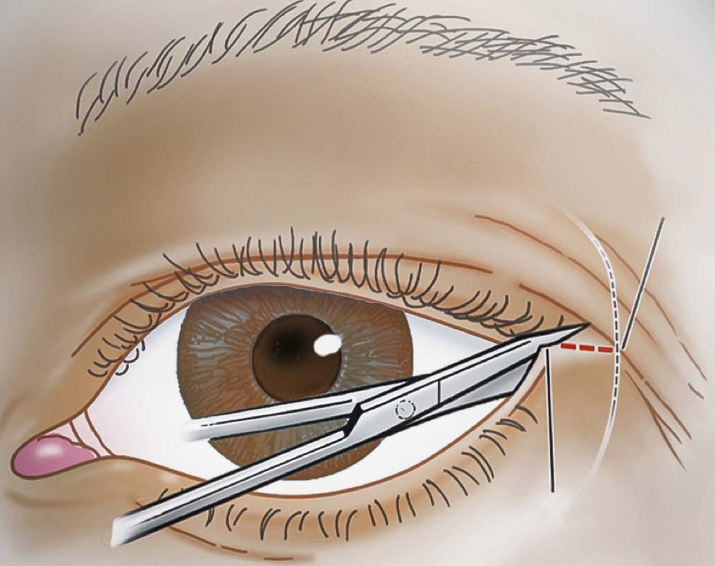 Ocular Trauma 1: Lid Lacerations and Orbital Compartment Syndrome episode artwork