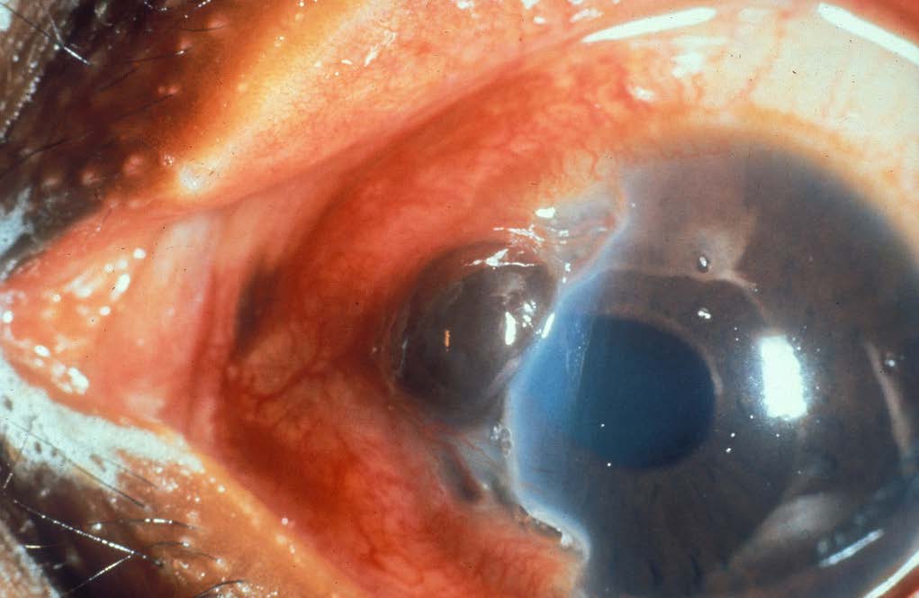 Ocular Trauma 2: Intraocular Foreign Bodies and Globe Rupture episode artwork